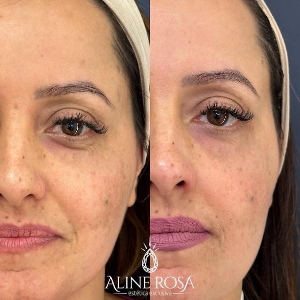 Gerenciamento de Melasma